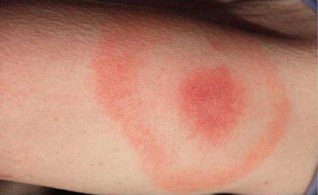 lyme disease symptoms
