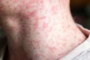 measles