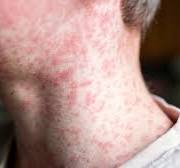 measles