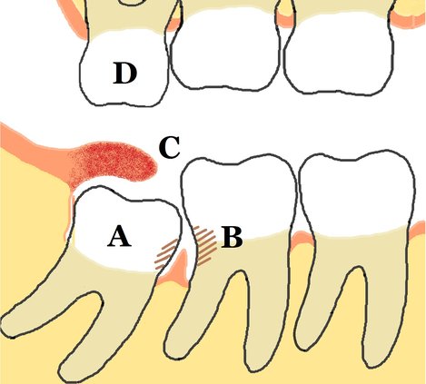 Wisdom teeth